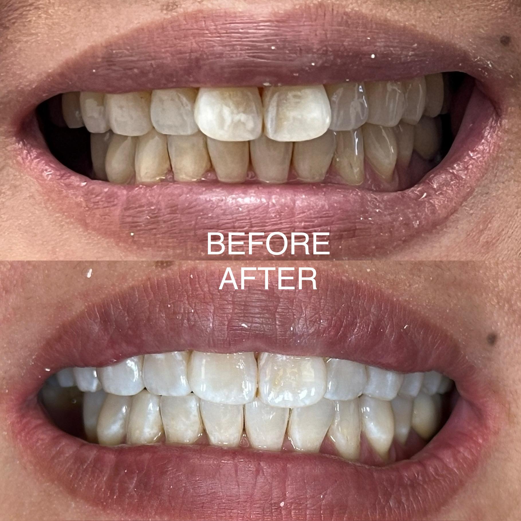 Teeth whitening woman