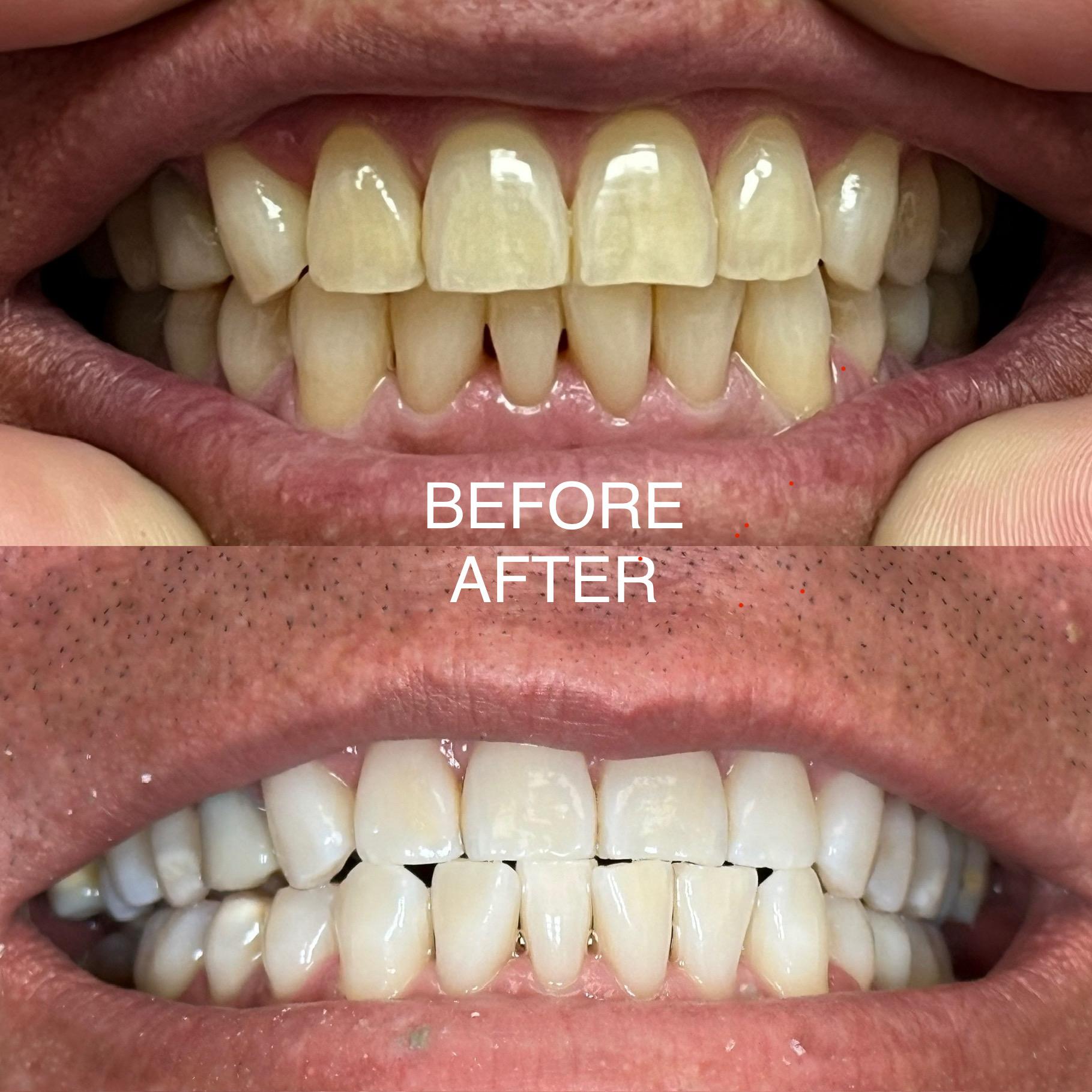 Man with nice teeth after whitening service