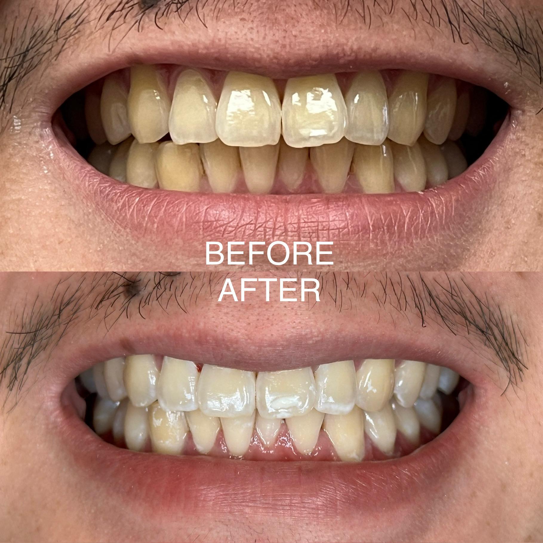 A young man with teeth whitening before and after