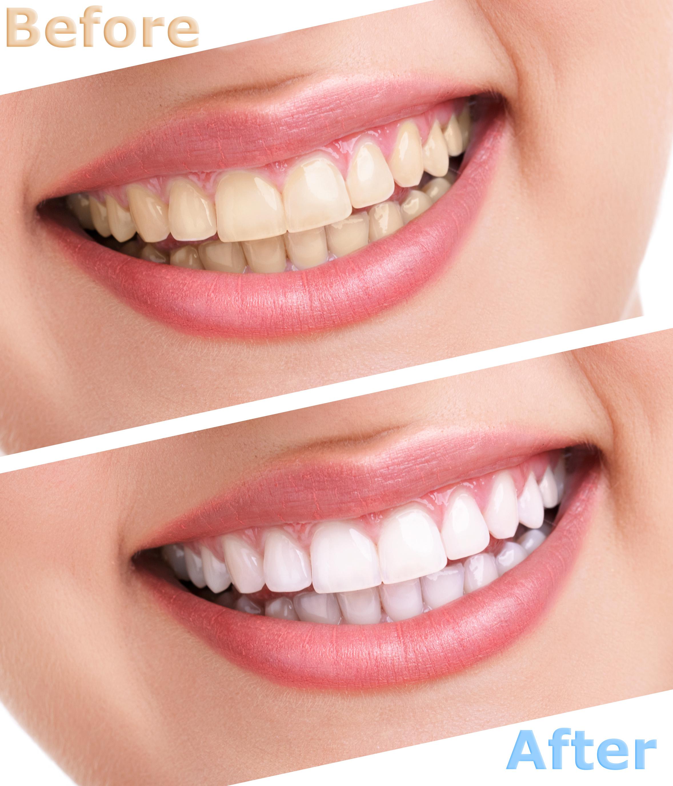 teeth whitening services in San Ramon