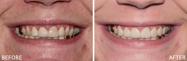 cosmetic veneers to correct smile irregularities