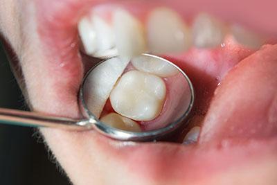 composite filing alternative to metal amalgam dentistry