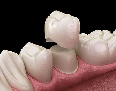 dental crown for restorative dentistry in San Ramon