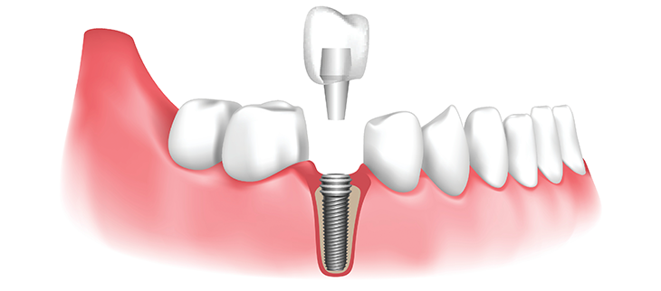 Dental implant restorations