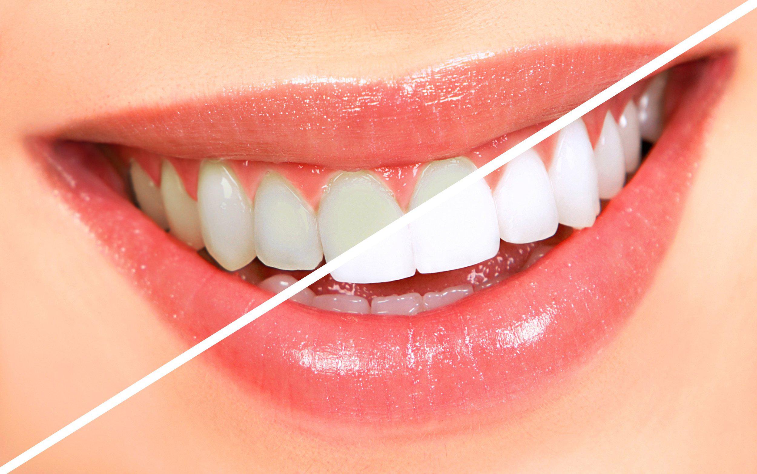 How safe is teeth whitening in San Ramon, CA