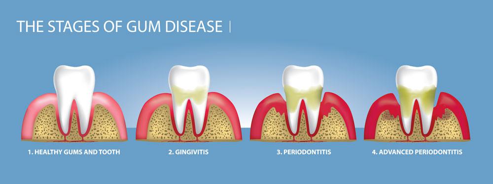 the stages of gum disease